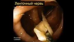 Ленточный червь  Лучший клинический случай группы за октябрь 2017